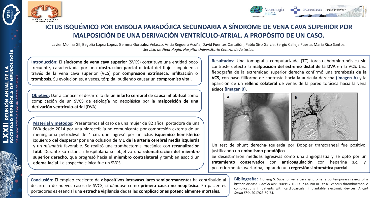 Ictus isquémico por embolia paradójica secundaria a síndrome de vena cava superior por malposición de una derivación ventrículo-atrial. A propósito de un caso.