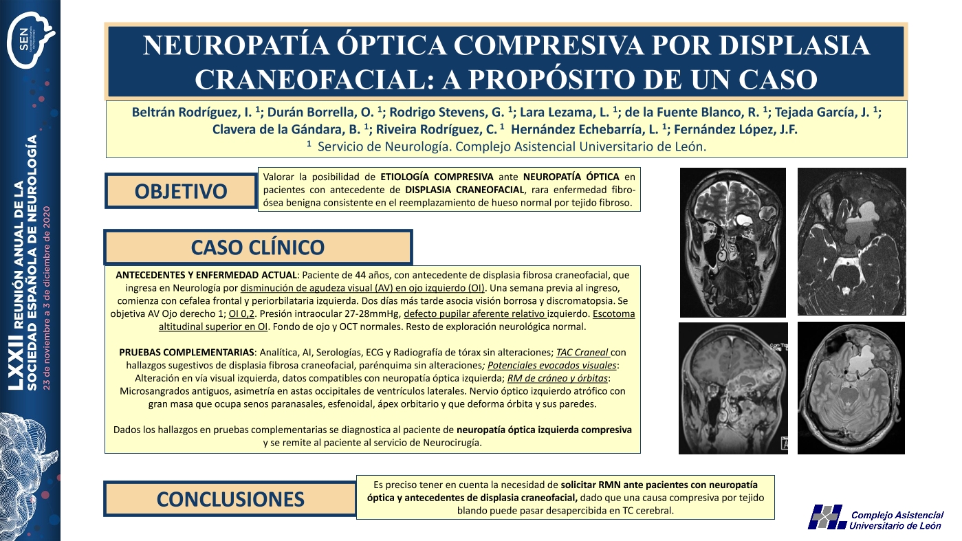 Neuropatía óptica compresiva por displasia craneofacial: A propósito de un caso