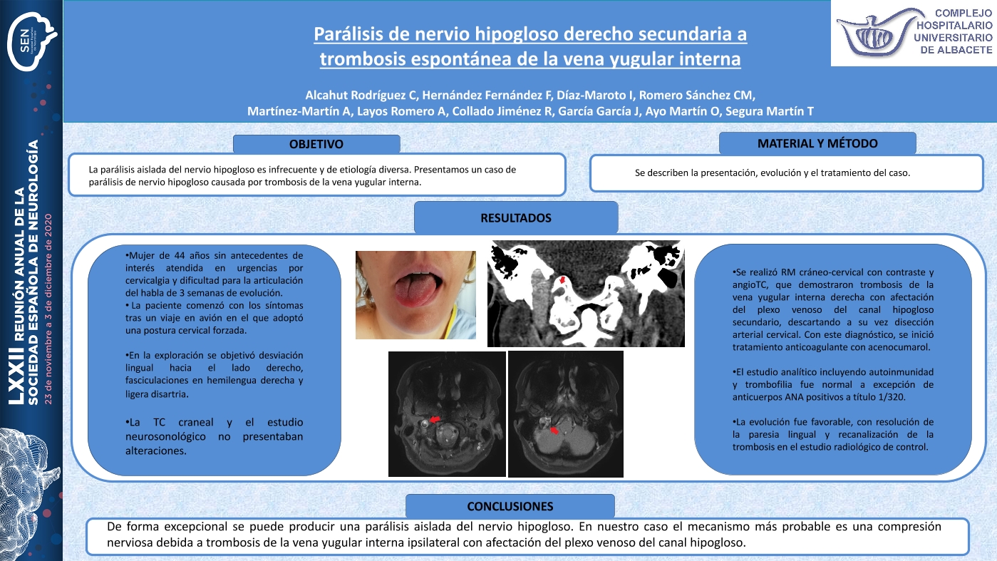 Parálisis de nervio hipogloso derecho secundaria a trombosis espontánea de la vena yugular interna