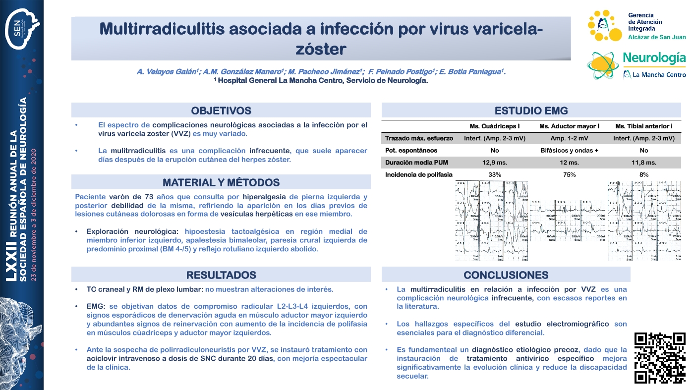 Multirradiculitis asociada a infección por virus varicela-zóster