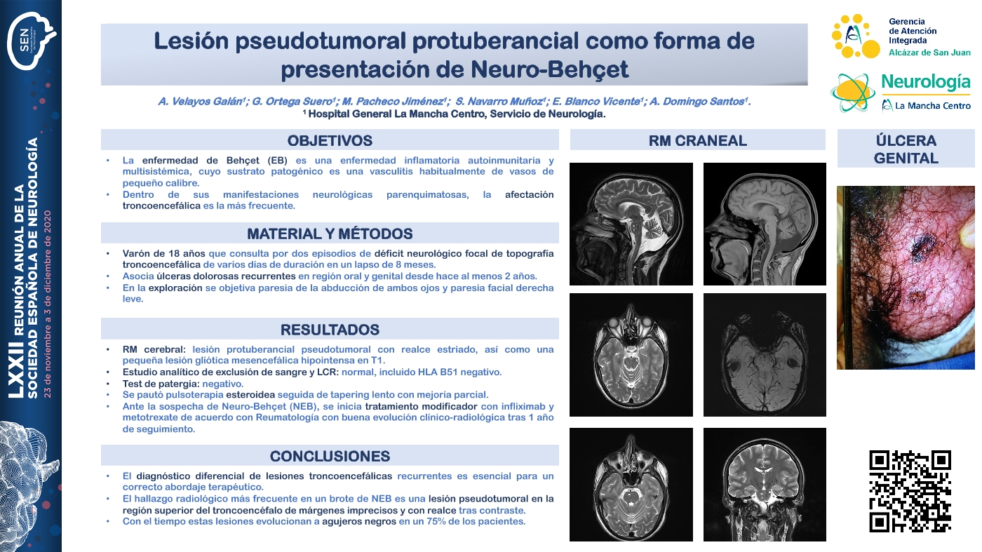 Lesión pseudotumoral protuberancial como forma de presentación de Neuro-Behçet