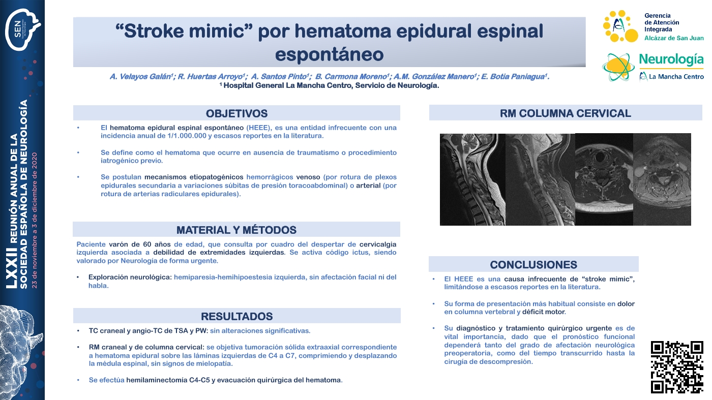 “Stroke mimic” por hematoma epidural espinal espontáneo
