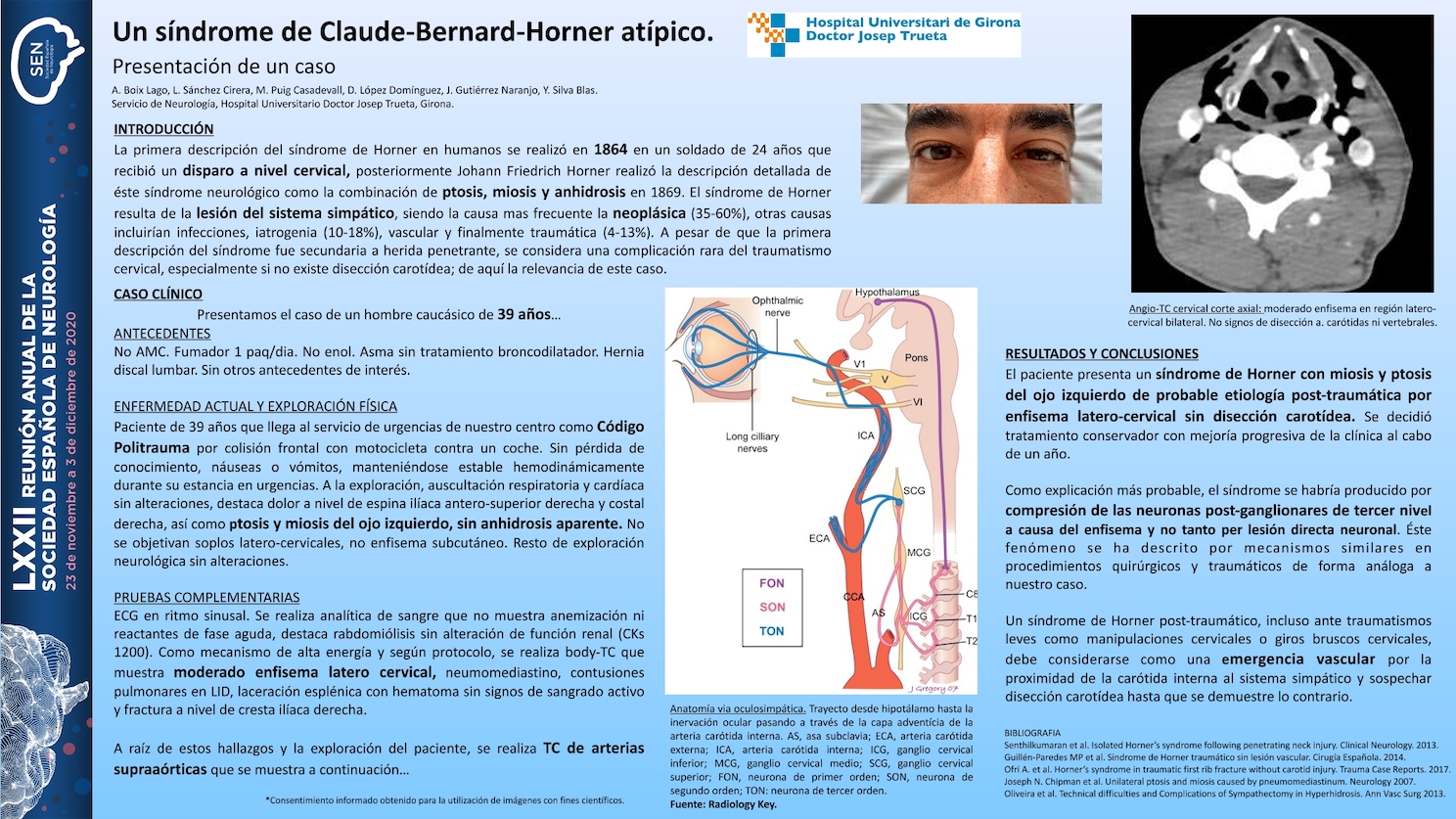 Síndrome de Claude-Bernard-Horner post-traumático sin lesión vascular. Presentación de un caso