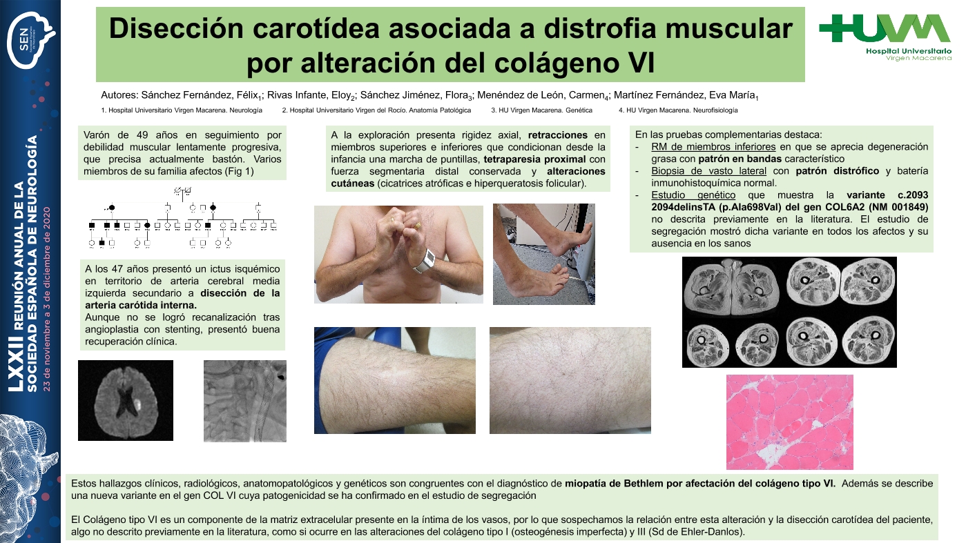 Disección carotídea asociada a distrofia muscular por alteración del colágeno VI