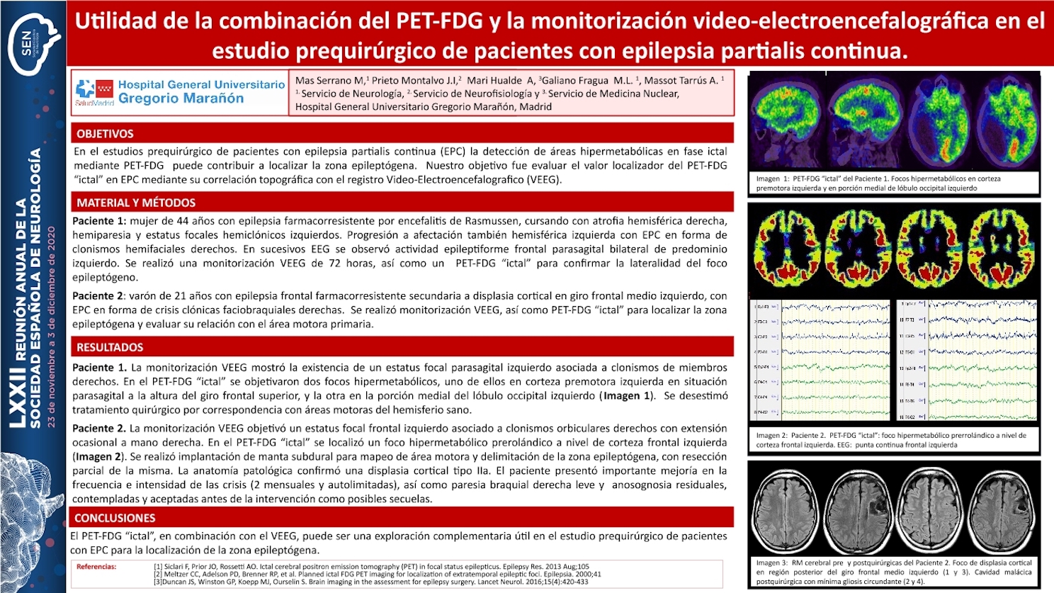 Utilidad de la combinación del PET-FDG y la monitorización video-electroencefalográfica en el estudio prequirúrgico de pacientes con epilepsia partialis continua.