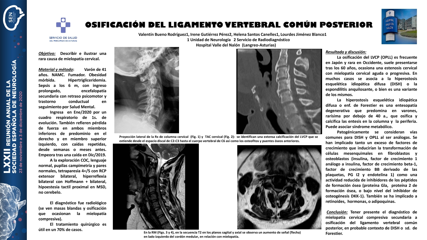 Osificación del ligamento longitudinal vertebral posterior (OPLL): una rara causa de mielopatía cervical