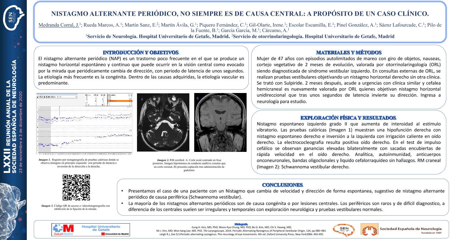 Nistagmo alternante periódico; no siempre es de causa central: a propósito de un caso clínico