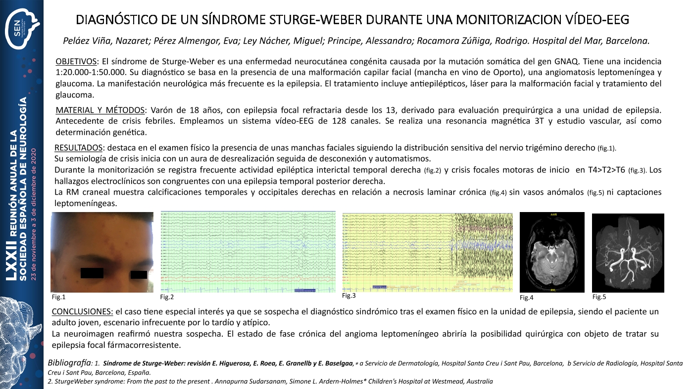 Diagnóstico de un síndrome de Sturge-Weber durante una monitorización vídeo-EEG