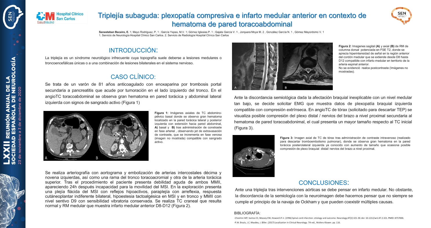 Triplejía subaguda: plexopatía compresiva e infarto medular anterior en contexto de hematoma de pared toracoabdominal