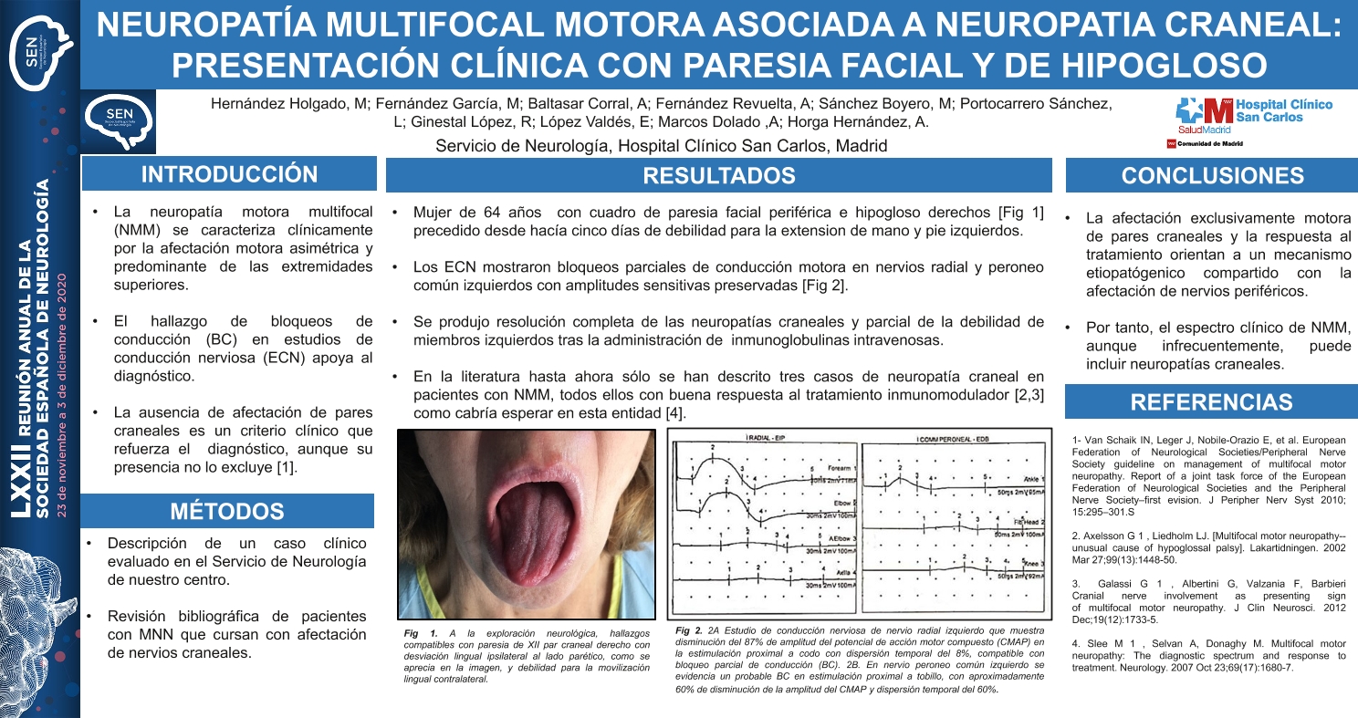 Neuropatía multifocal motora asociada a neuropatía craneal: presentación clínica con paresia facial y de hipogloso