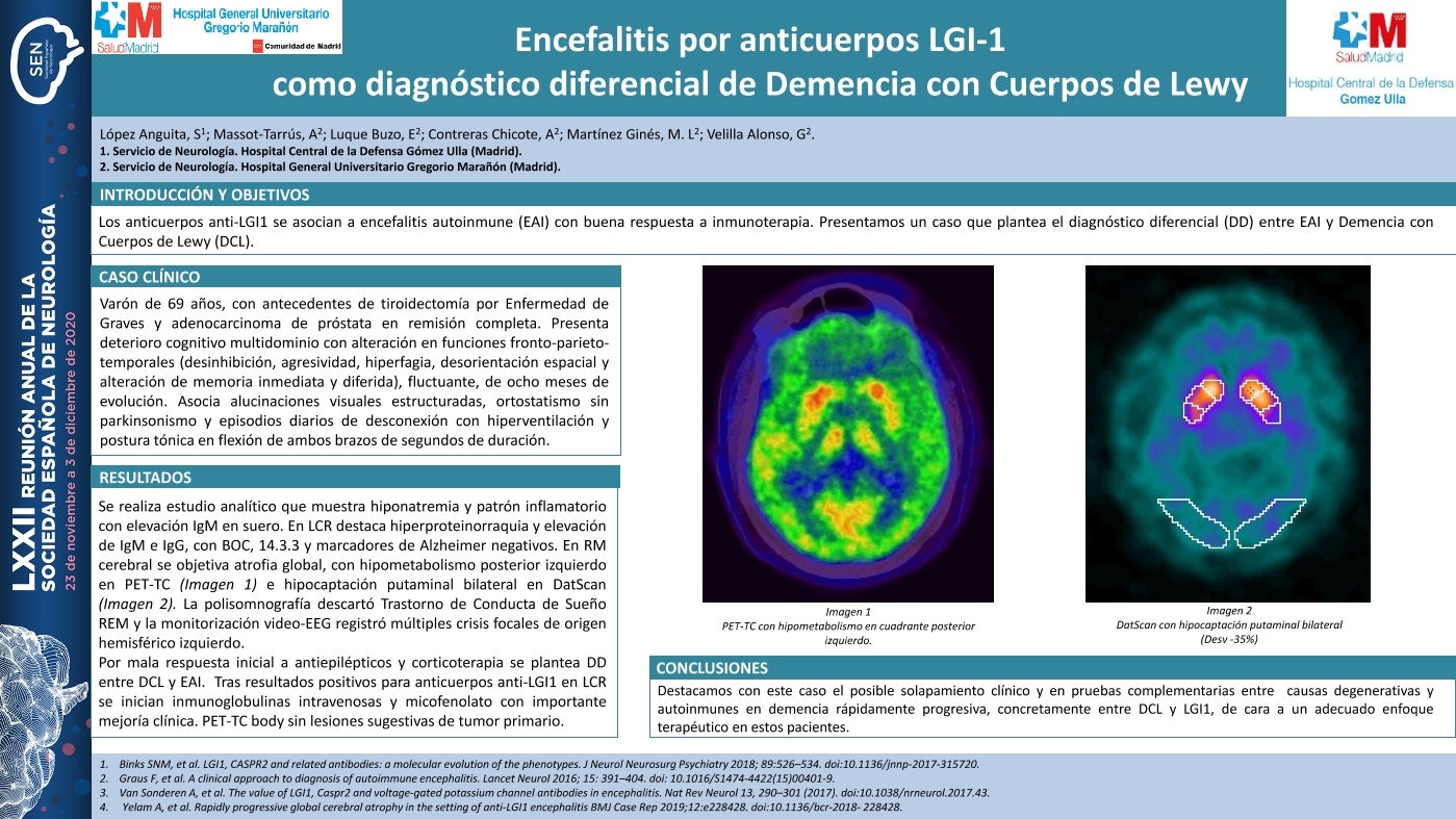 Encefalitis por anticuerpos LGI-1 como diagnóstico diferencial de Demencia con Cuerpos de Lewy