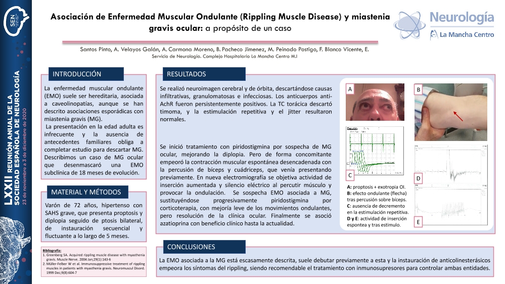 Asociación de Enfermedad Muscular Ondulante (Rippling Muscle Disease) y miastenia gravis ocular: a propósito de un caso