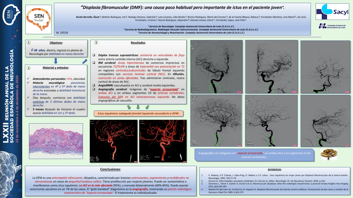 Displasia fibromuscular (DMF): una causa poco habitual pero importante de ictus en el paciente joven