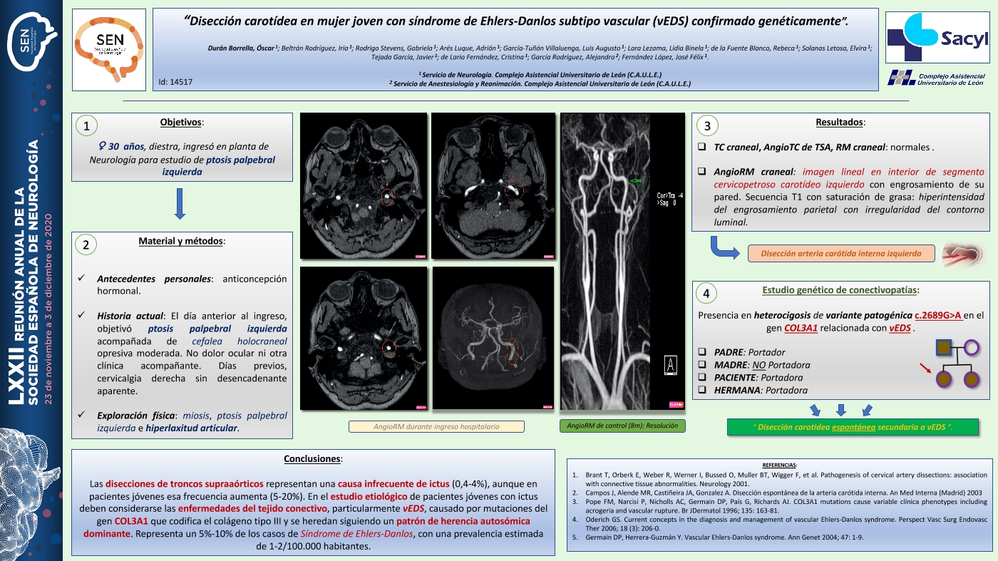 Disección carotídea en mujer joven con síndrome de Ehlers-Danlos subtipo vascular (vEDS) confirmado genéticamente