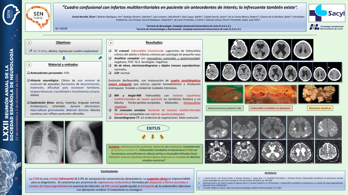 Cuadro confusional con infartos multiterritoriales en paciente sin antecedentes de interés. Lo infrecuente también existe