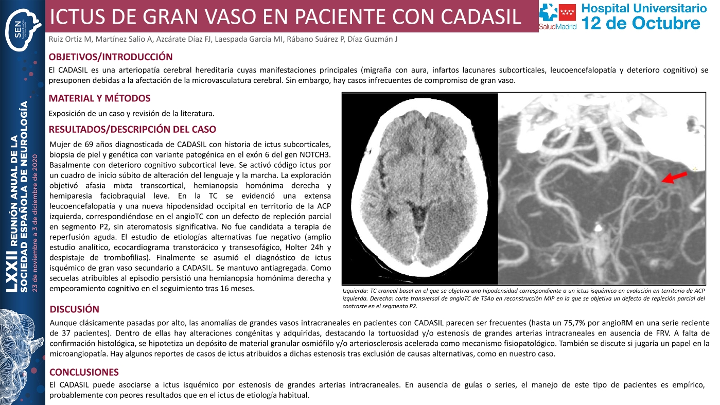 Ictus de gran vaso en un paciente con CADASIL