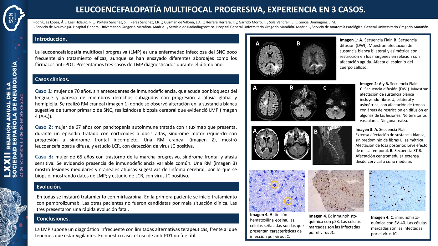 Leucoencefalopatía multifocal progresiva, experiencia en 3 casos