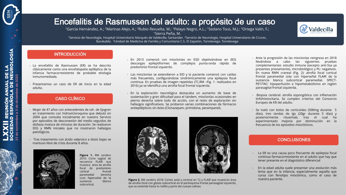 Encefalitis de Rasmussen del adulto: a propósito de un caso