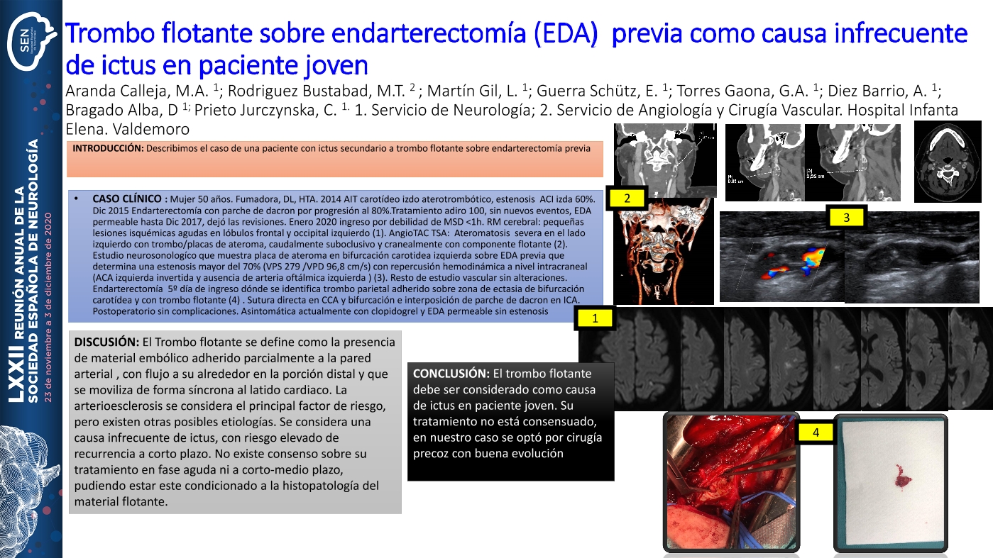 Trombo flotante sobre endarterectomía (EDA)  previa como causa infrecuente de ictus en paciente joven