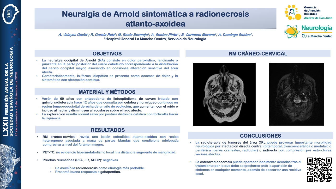 Neuralgia de Arnold sintomática a radionecrosis atlanto-axoidea