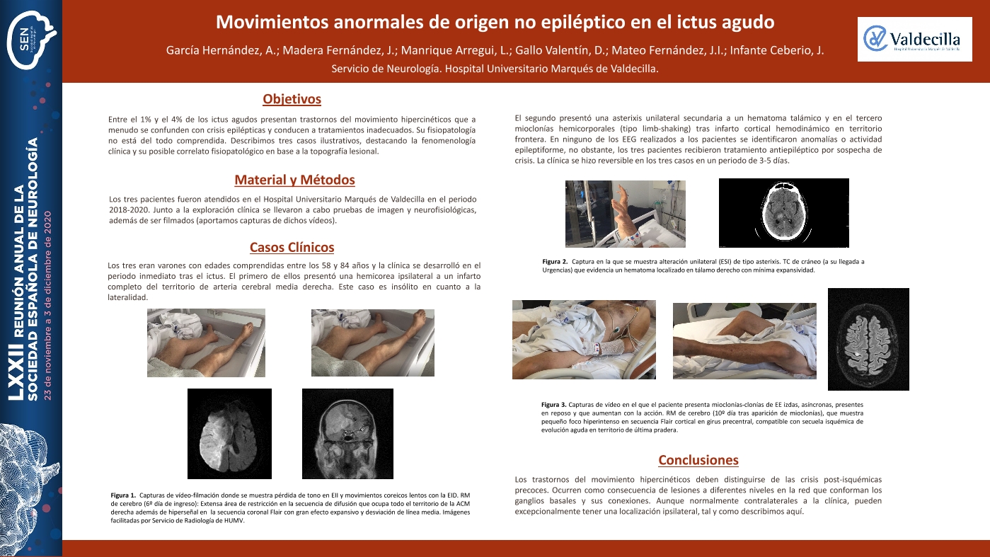 Movimientos anormales de origen no epiléptico en el ictus agudo