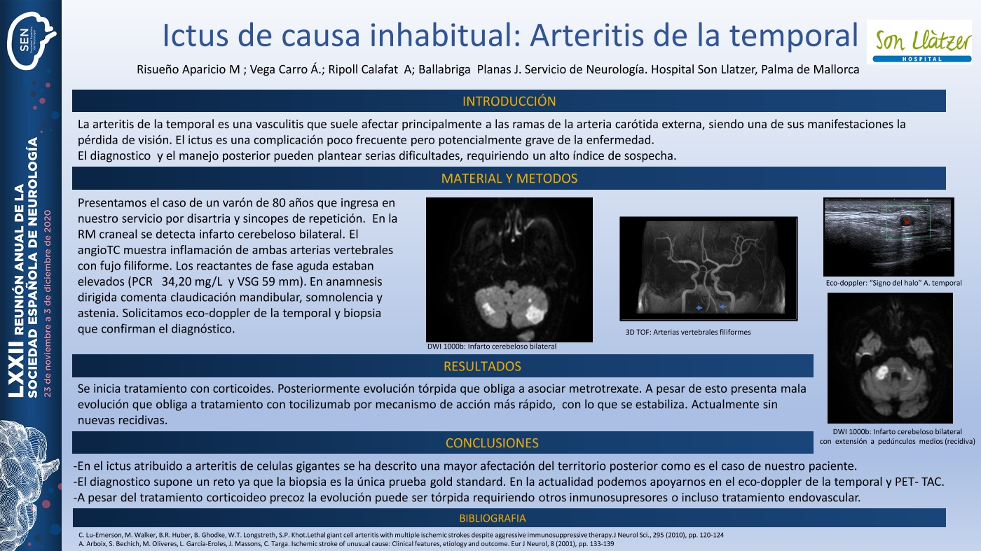 Ictus de causa inhabitual: arteritis de la temporal