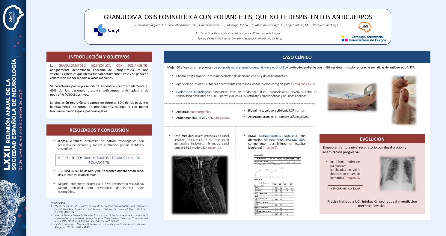 Granulomatosis eosinofílica con poliangeitis, que no te despisten los anticuerpos