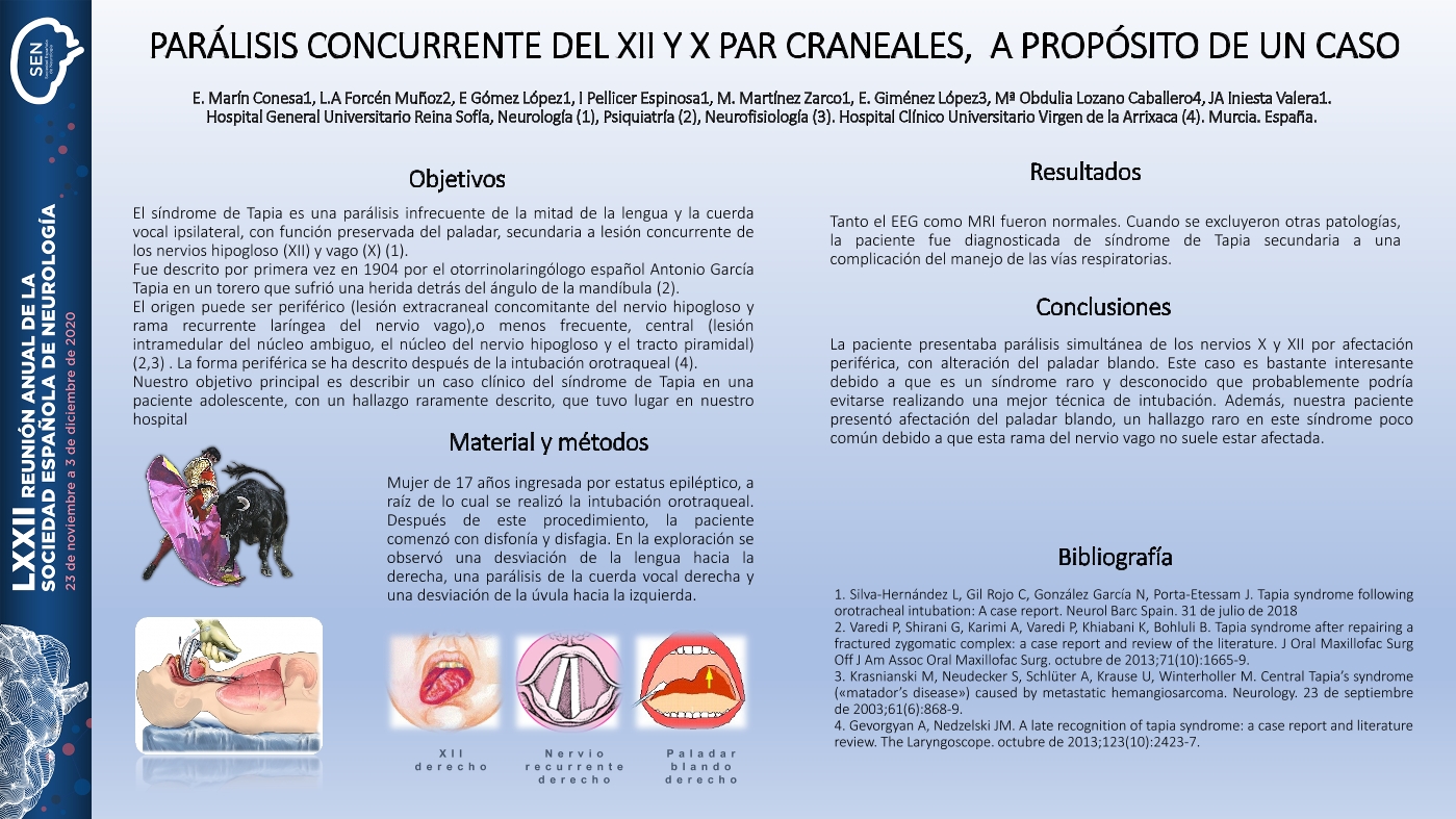 Parálisis concurrente del XII y X par craneales, a propósito de un caso