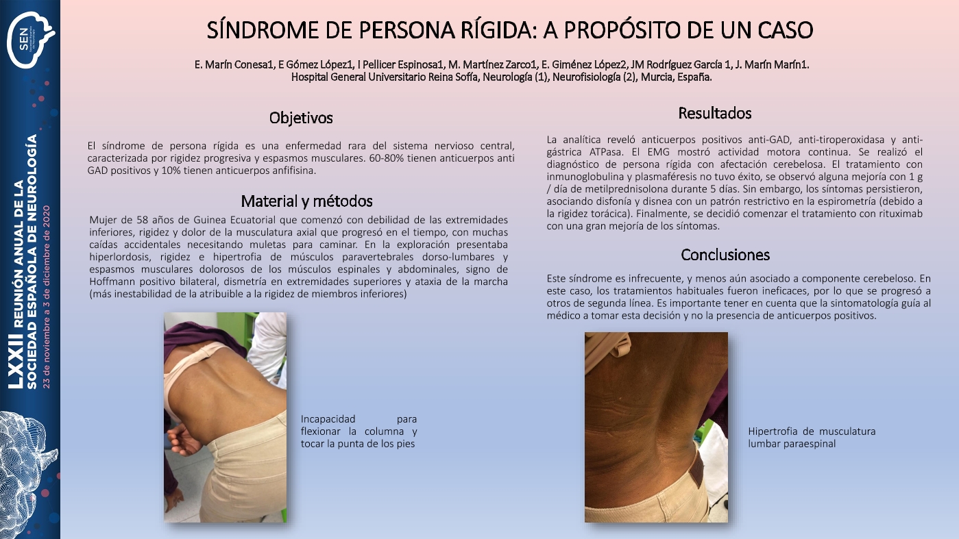 Síndrome de persona rígida: a propósito de un caso
