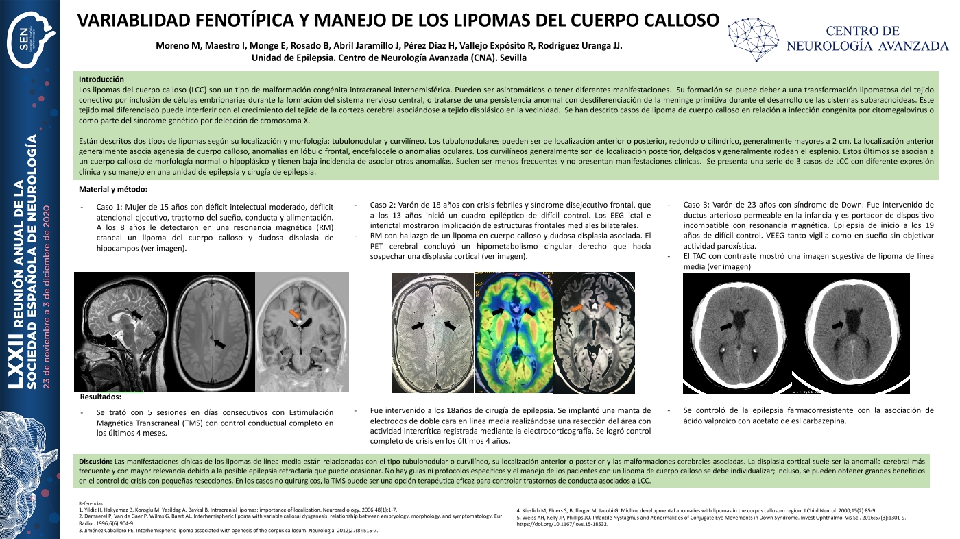 Variablidad fenotípica y manejo de los lipomas del cuerpo calloso