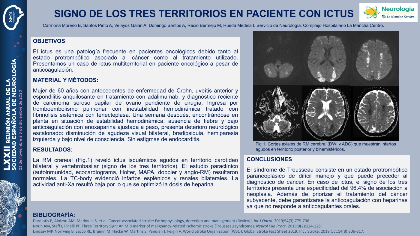 Signo de los tres territorios en paciente con ictus