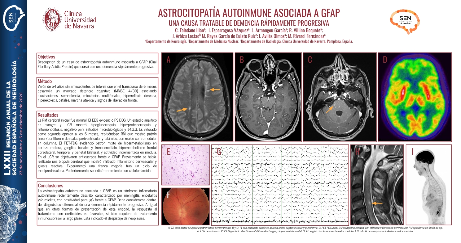 Astrocitopatía autoinmune asociada a GFAP: una causa tratable de demencia rápidamente progresiva