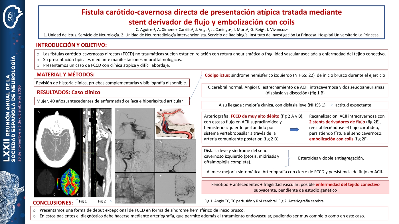 Fístula carótido-cavernosa directa de presentación atípica tratada mediante stent derivador de flujo y embolización con coils