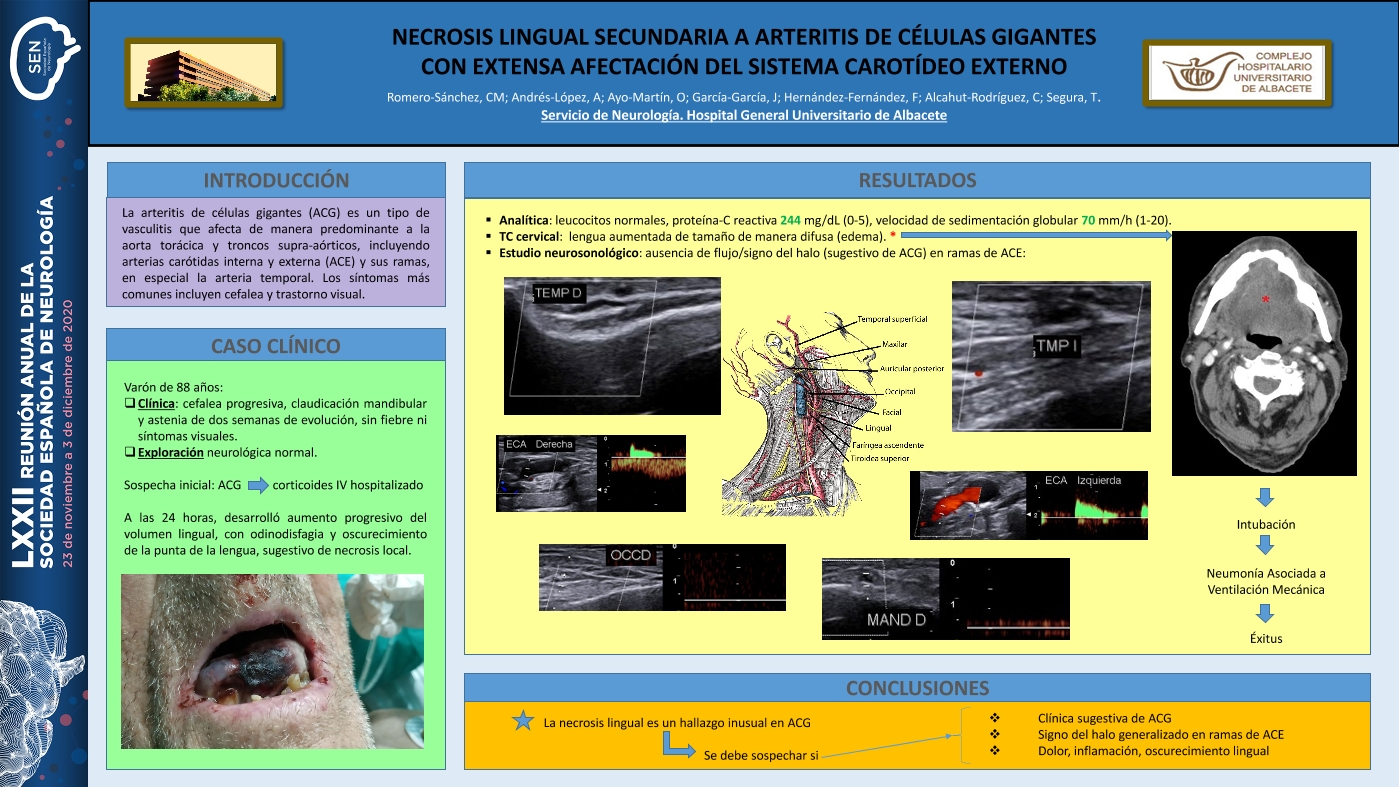 Necrosis lingual secundaria a arteritis de células gigantes con extensa afectación del sistema carotídeo externo