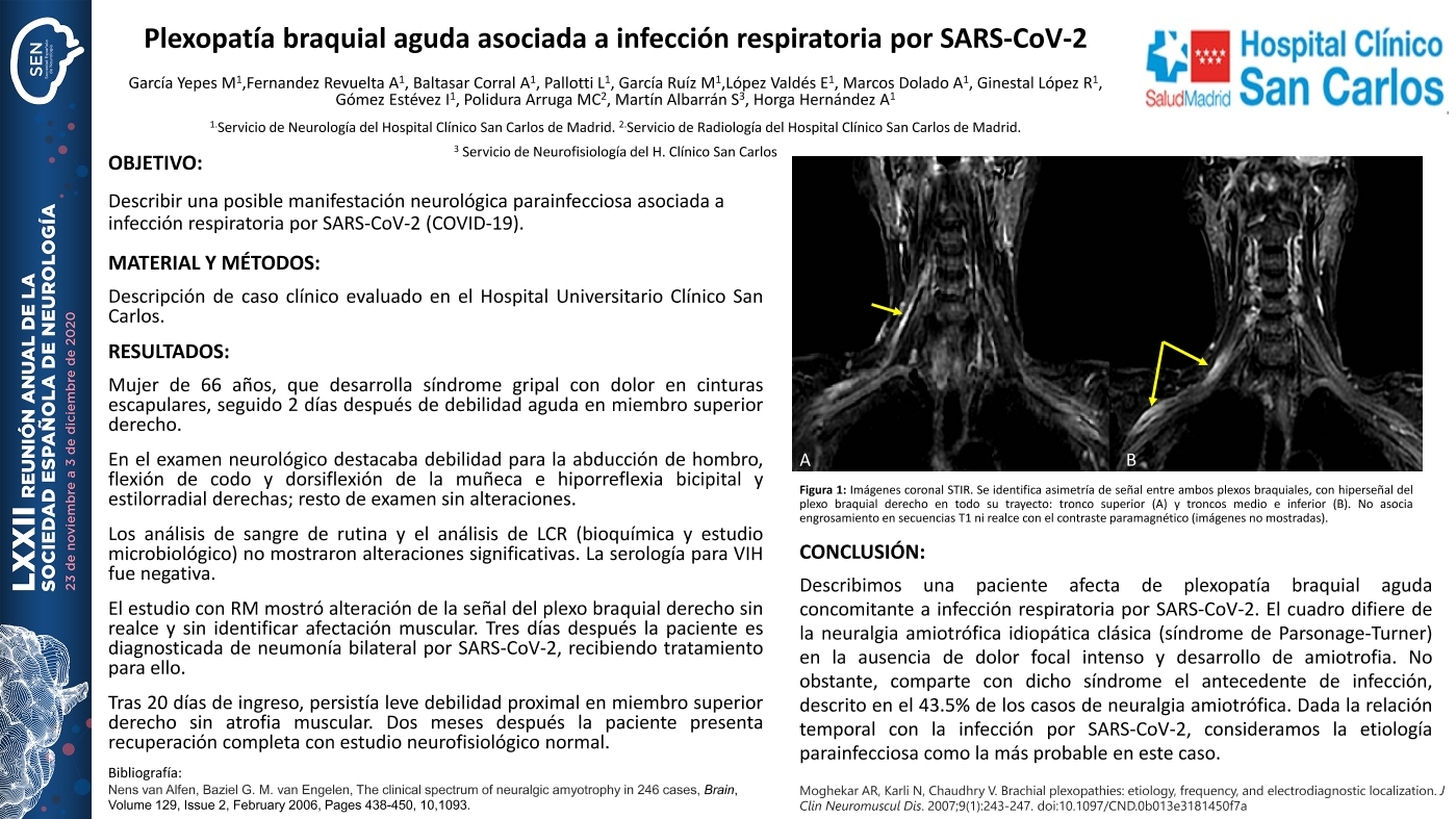 Plexopatía braquial aguda asociada a infección respiratoria por SARS-CoV-2