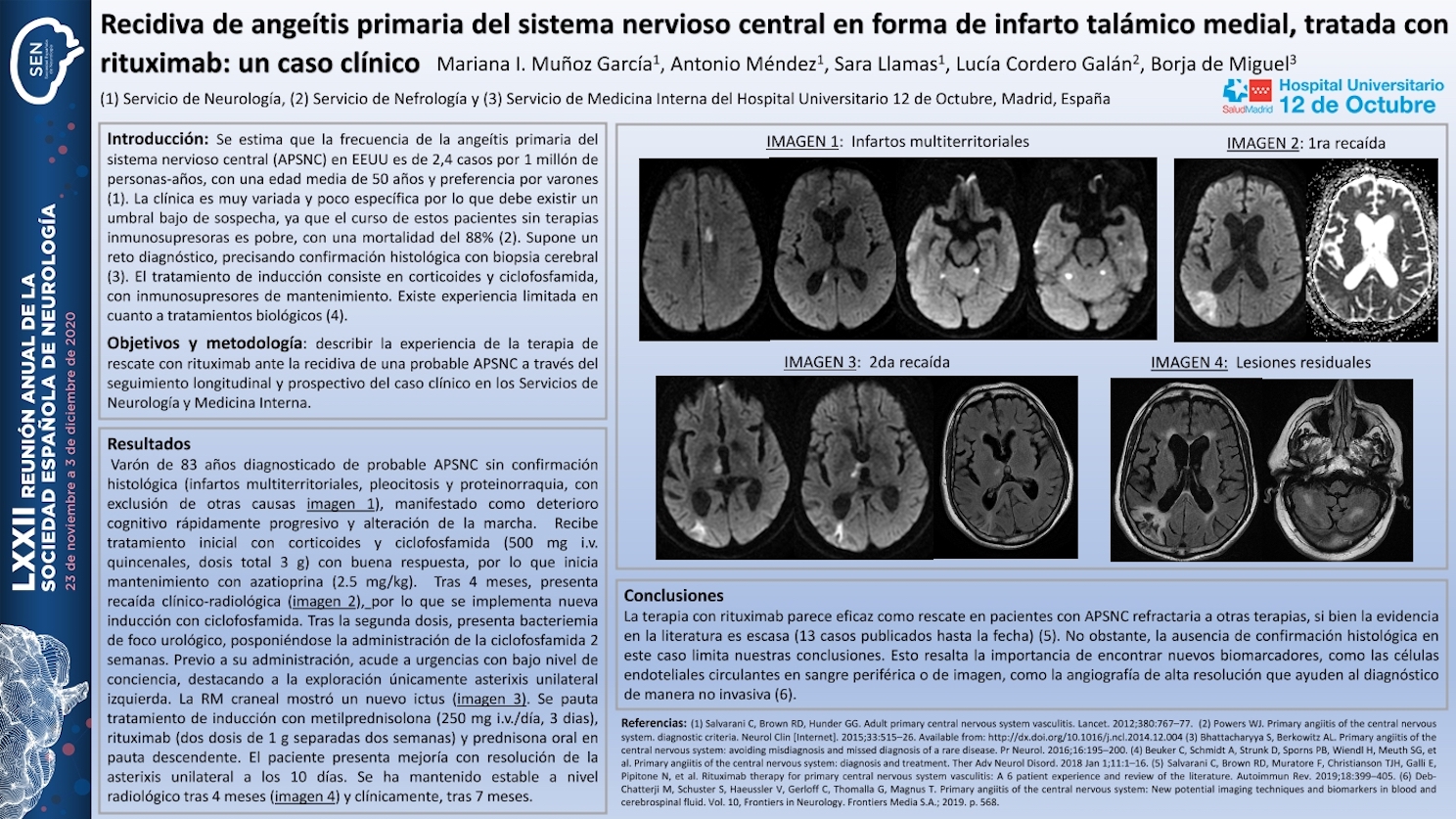 Recidiva de angeítis primaria del sistema nervioso central en forma de infarto talámico medial, tratada con rituximab: un caso clínico