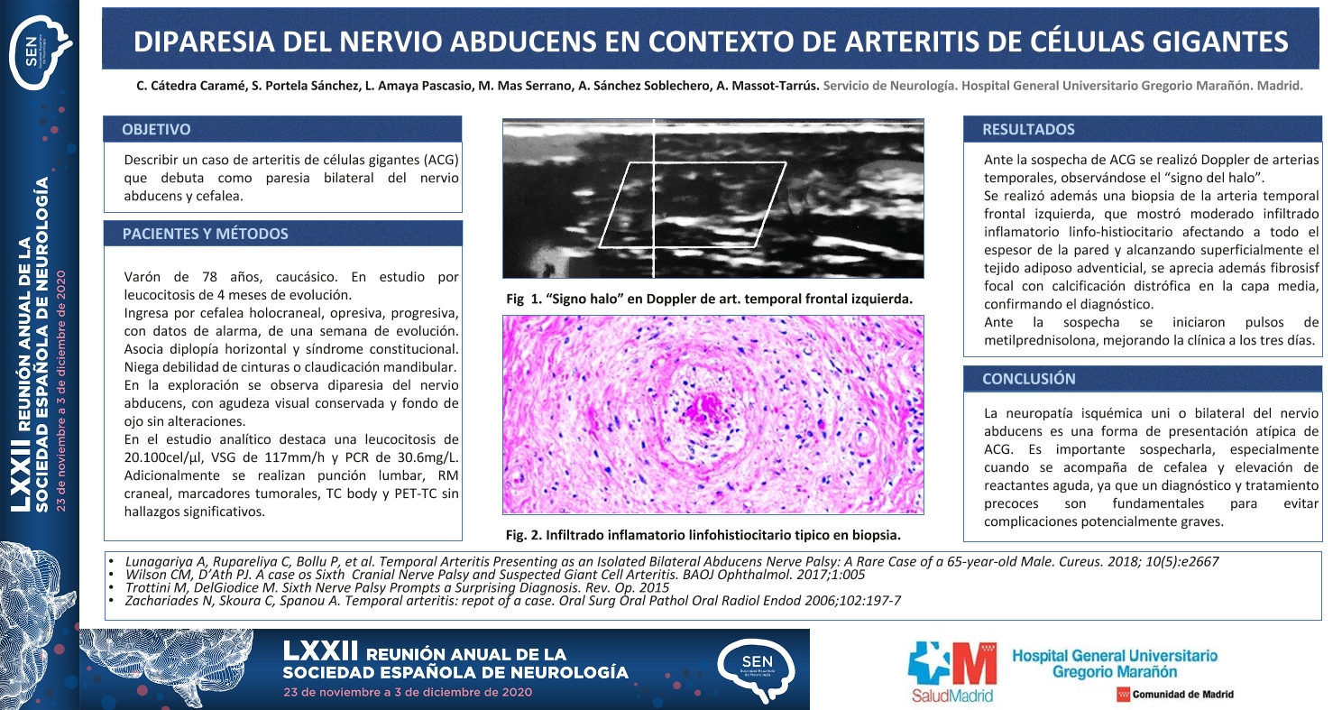 Diparesia del nervio Abducens en contexto de Arteritis de Células Gigantes