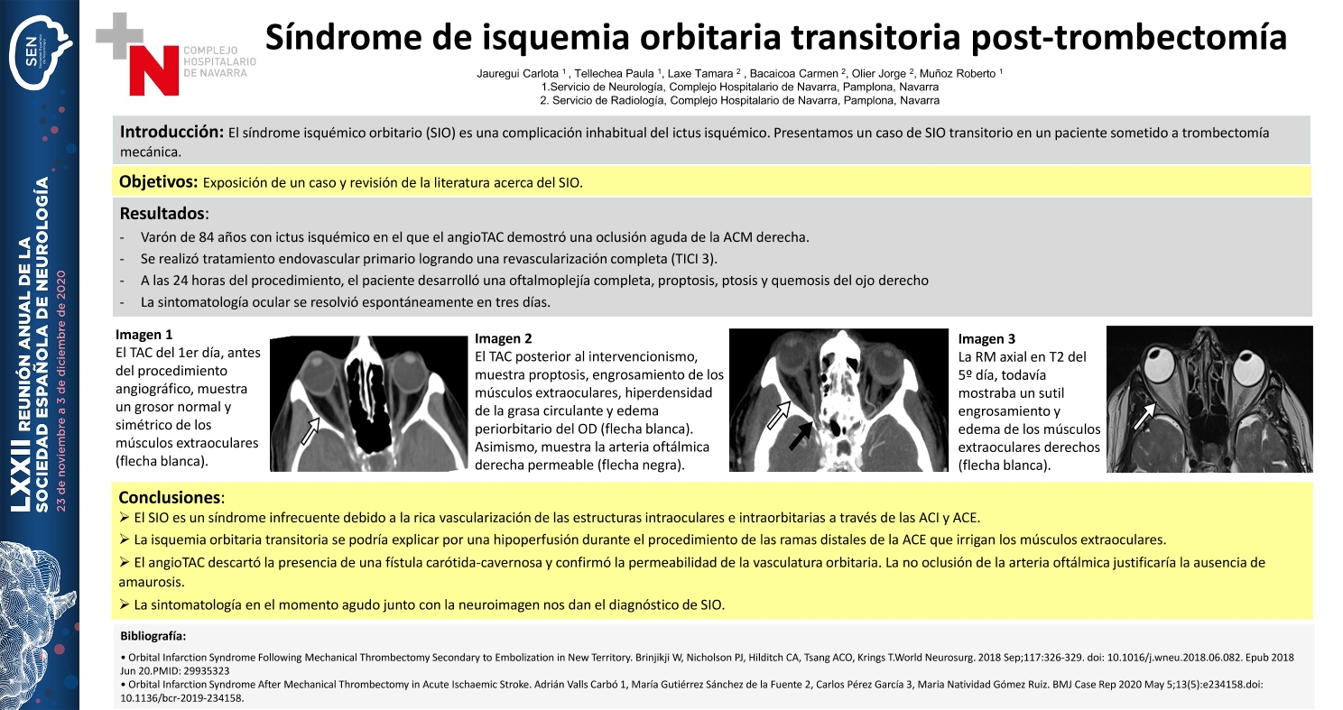 Síndrome de isquemia orbitaria transitoria post-trombectomía
