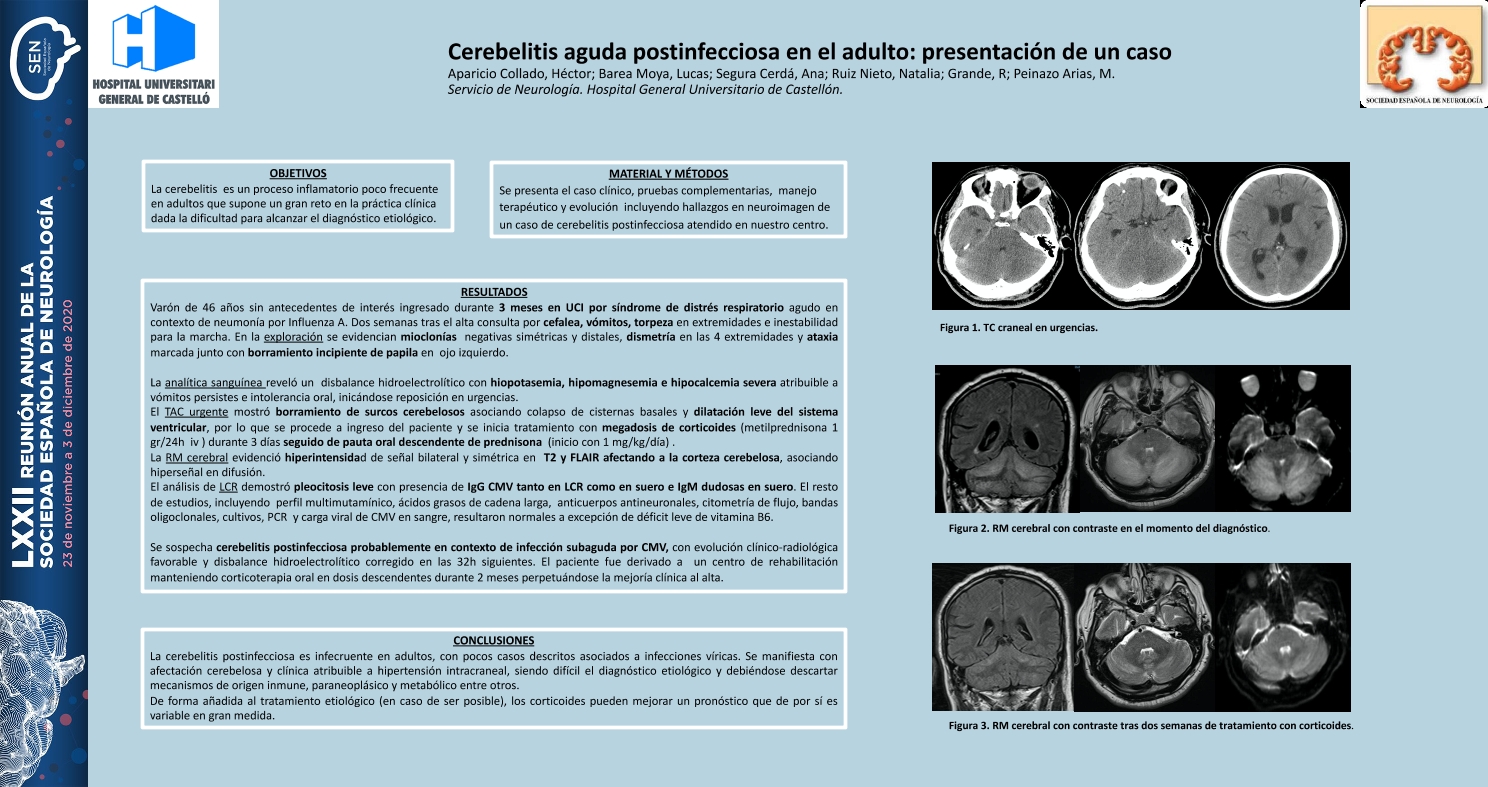 Cerebelitis aguda postinfecciosa en el adulto: presentación de un caso