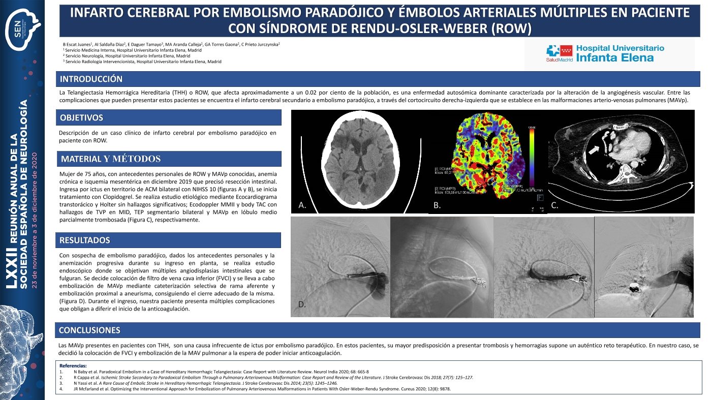 Infarto cerebral por embolismo paradójico y émbolos arteriales múltiples en paciente con Sd. Rendu-Osler-Weber (ROW)