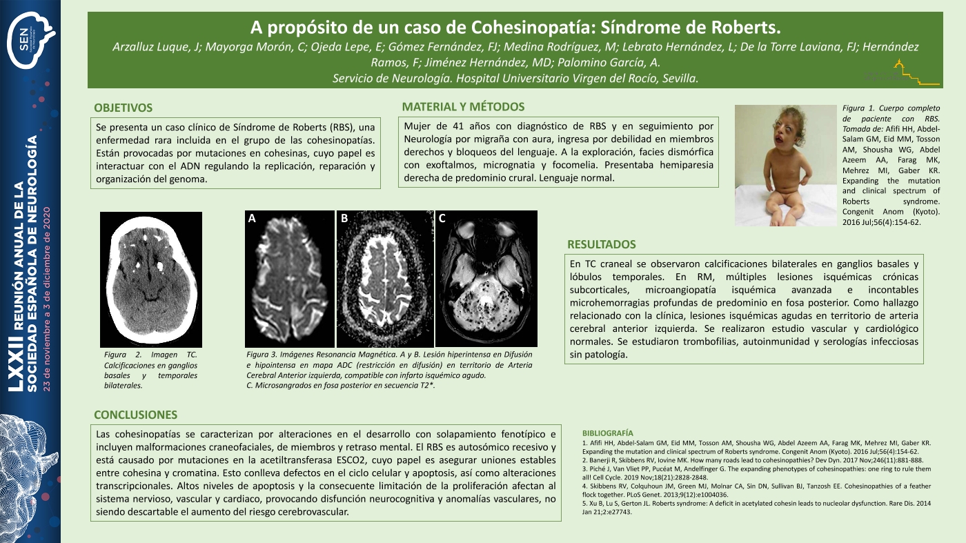 A propósito de un caso de Cohesinopatía: Síndrome de Roberts