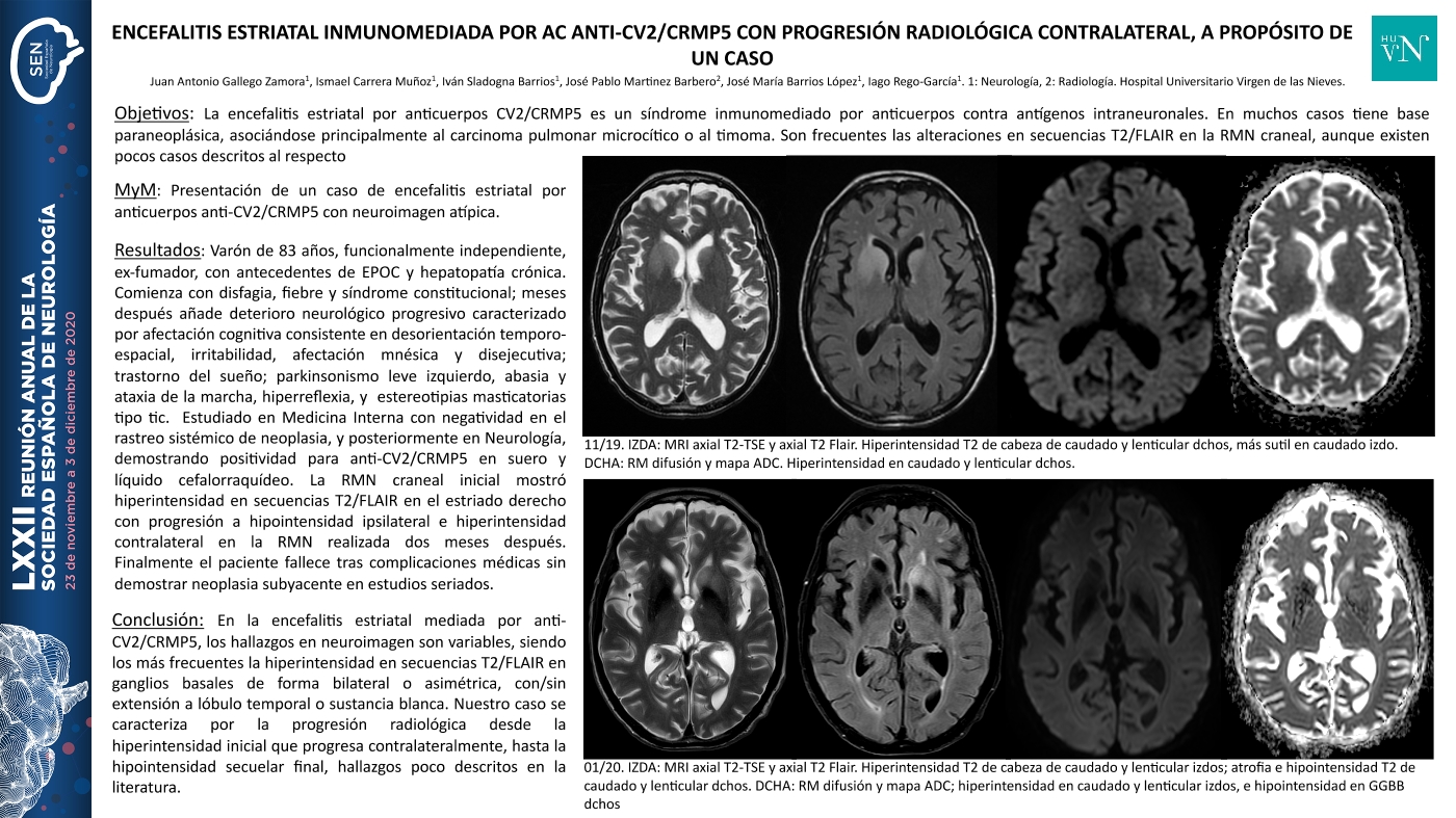 Encefalitis estriatal inmunomediada por ac anti-CV2/CRMP5 con progresión radiológica contralateral, a propósito de un caso