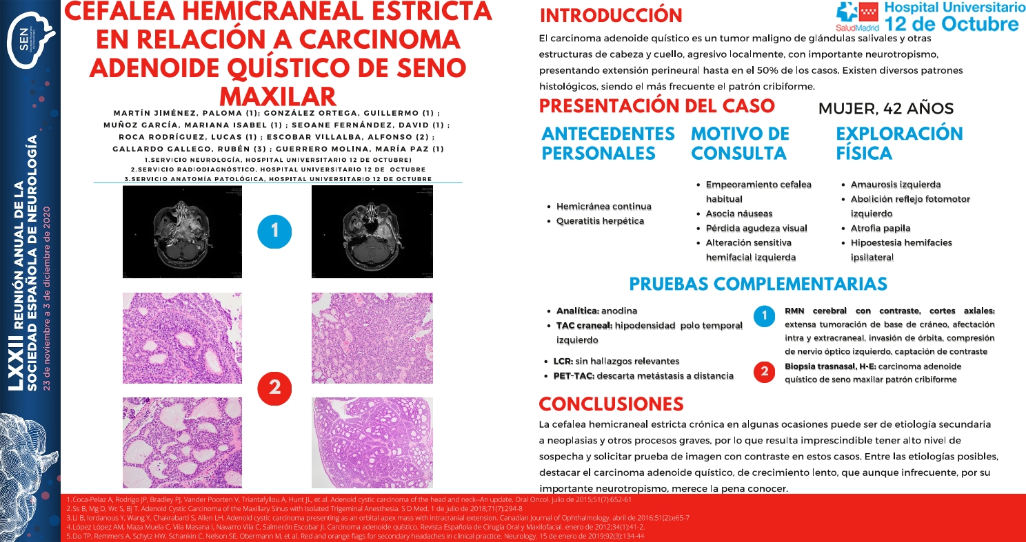 Cefalea hemicraneal estricta en relación a carcinoma adenoide quístico de seno maxilar