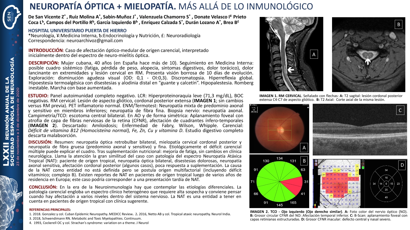 Neuropatía óptica subaguda + mielopatía. Más allá de lo inmunológico
