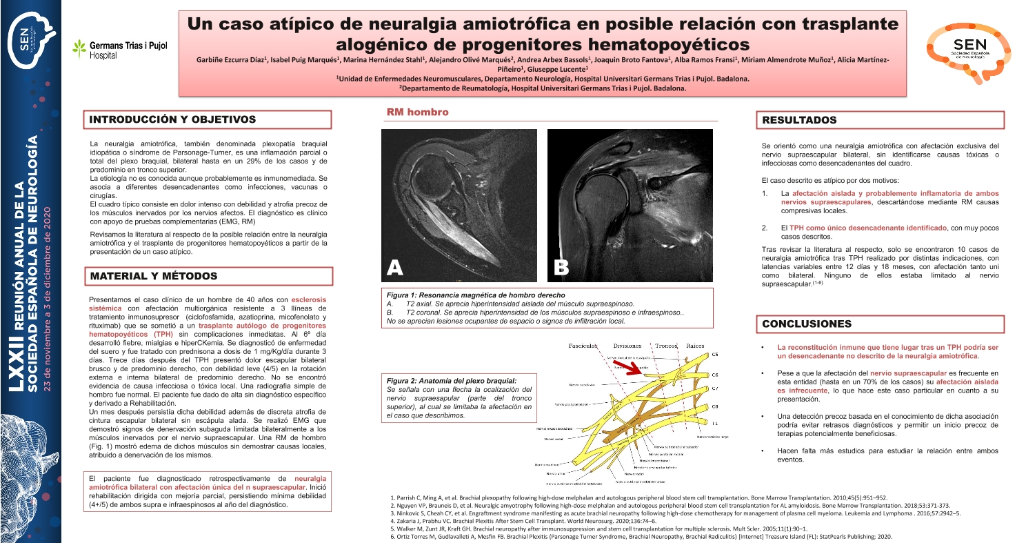Un caso atípico de neuralgia amiotrófica en posible relación con trasplante alogénico de progenitores hematopoyéticos y revisión de la literatura al respecto.