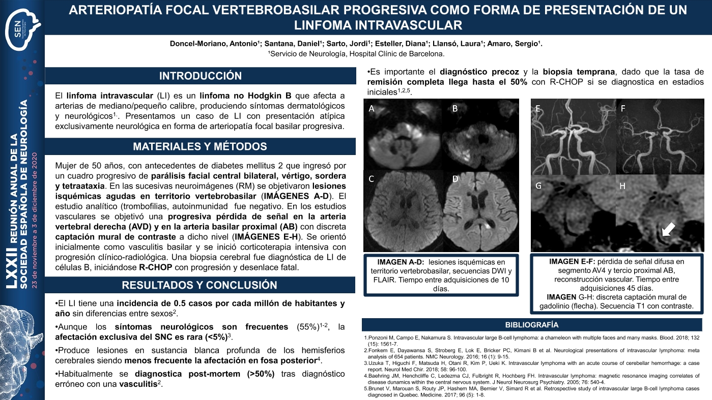 A propósito de un caso: arteriopatía focal rápidamente progresiva en el árbol vertebrobasilar como forma de presentación de un linfoma intravascular