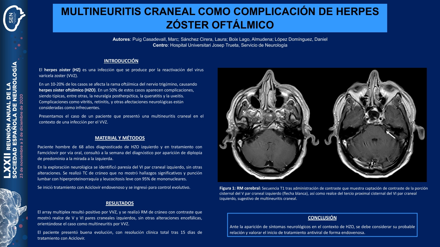 Multineuritis craneal como complicación de herpes zóster oftálmico