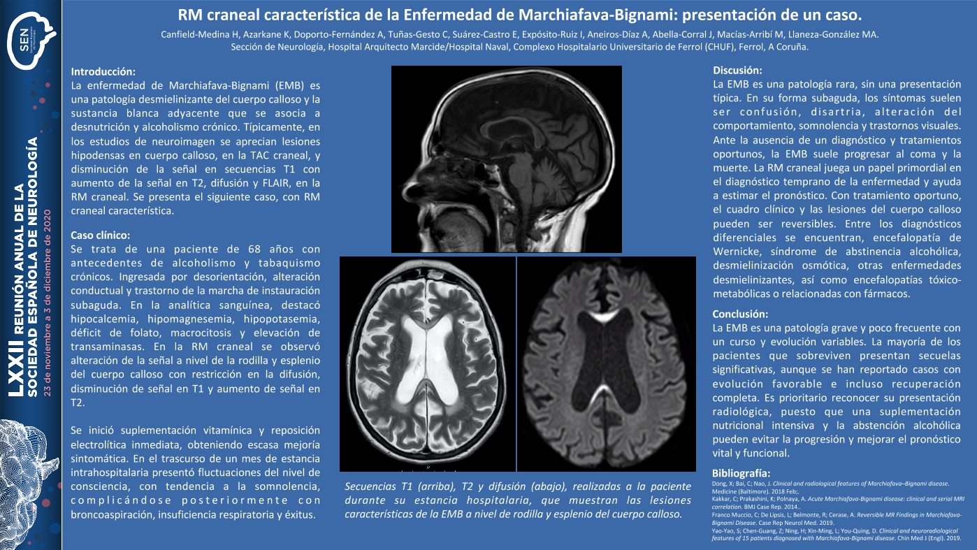 Enfermedad de Marchiafava-Bignami: presentación de un caso con hallazgos de neuroimagen característicos