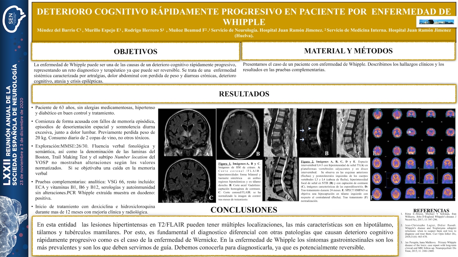 Deterioro cognitivo rapidamente progresivo por enfermedad de Whipple: a propósito de un caso.