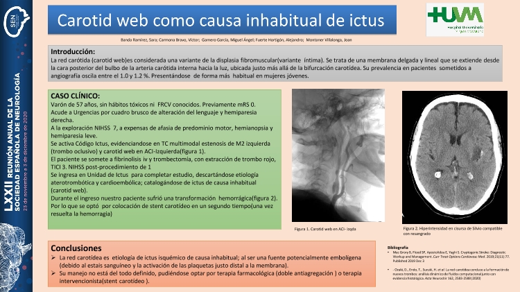 Carotid web como causa de ictus isquémico
